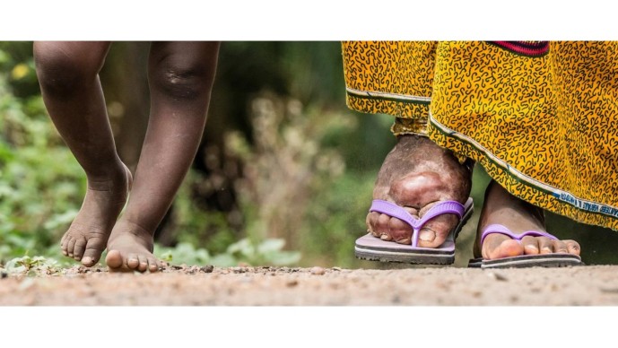 Diagnostics for Neglected Tropical Diseases - Lymphatic Filariasis